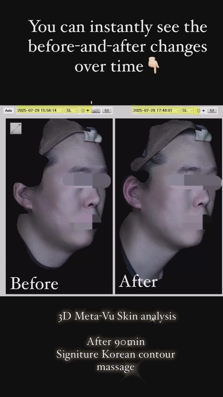 Signature Korean Contouring — 3D Meta-Vu 前后对比
